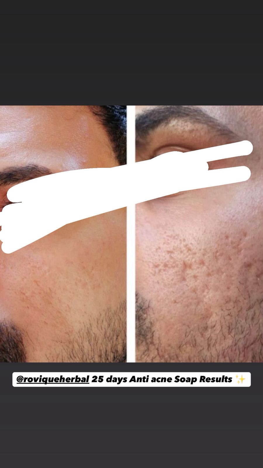 Anti Acne Soap